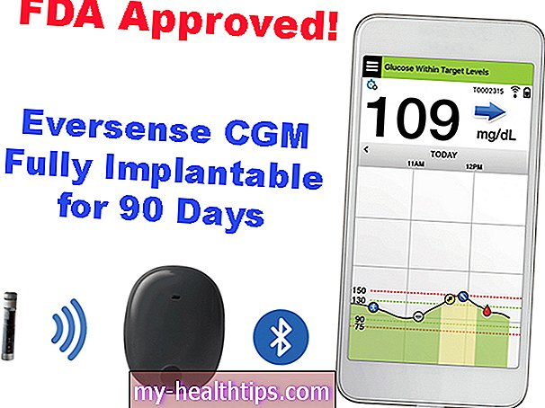 NEWS: Erstes implantierbares CGM (Eversense) erhält FDA-Zulassung!