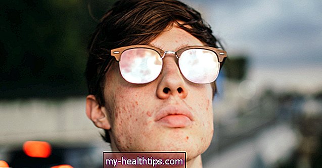 10 tratamientos para el acné para adolescentes