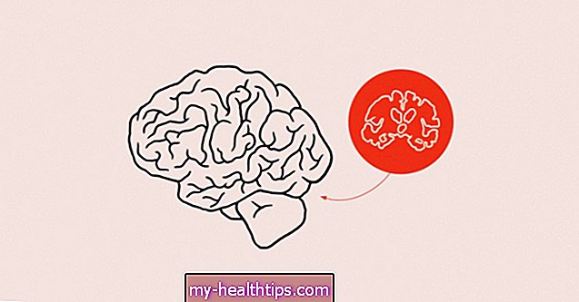 4 modi in cui la depressione può colpire fisicamente il cervello
