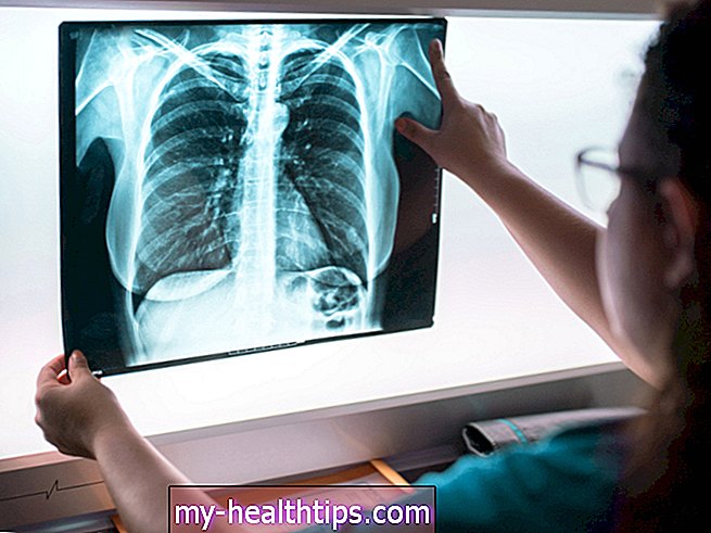 6 mitov o pljučnem raku, razkrinkano