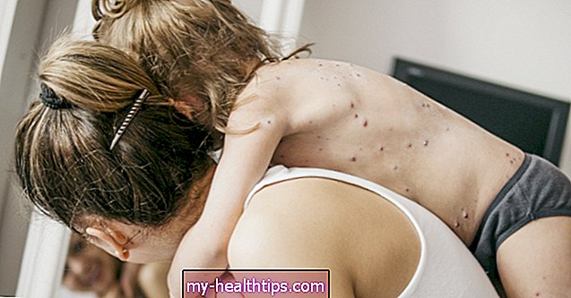 7 remedios caseros para la varicela