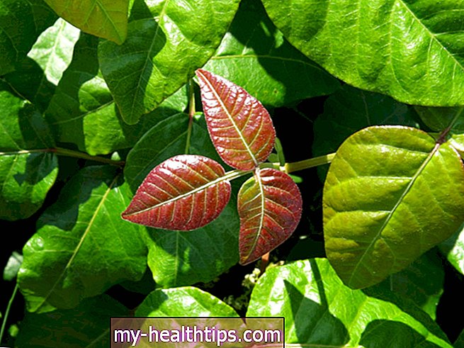 8 Poison Ivy gynimo priemonės ir prevencinės priemonės