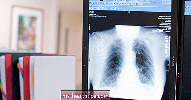 Saúde - Tudo sobre o carcinoma de células escamosas do pulmão