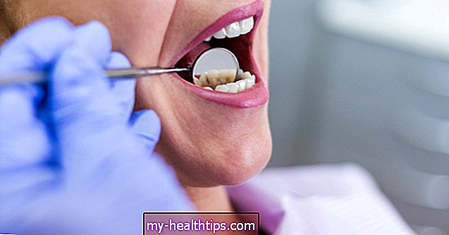 Visi mano dantys staiga sužeisti: 10 galimų paaiškinimų
