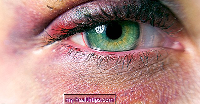 Najboljša domača zdravila za črne oči