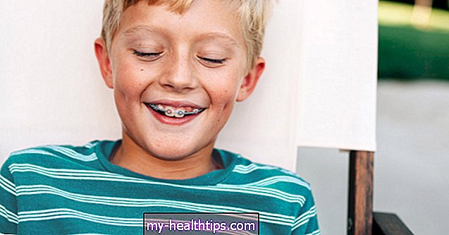 Beste Möglichkeiten, um die Zähne beim Tragen von Zahnspangen weiß zu halten