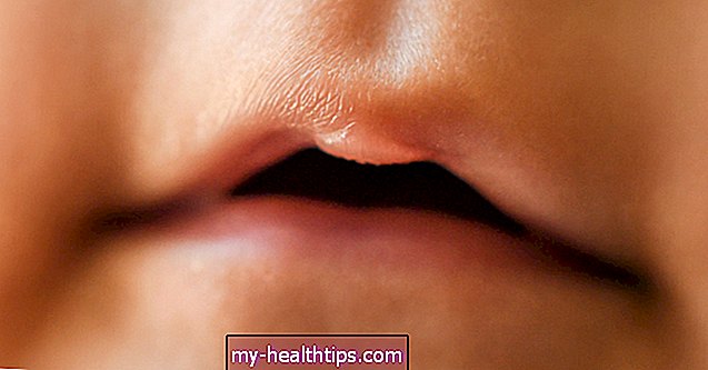Mjehurići na dječjim usnama: uzroci, tretmani i još mnogo toga