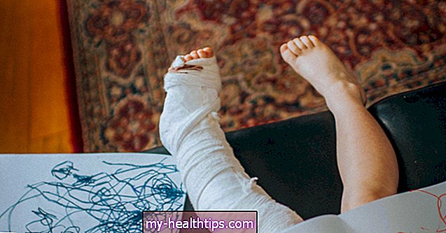Gebrochenes Bein: Symptome, Behandlung und Erholungszeit