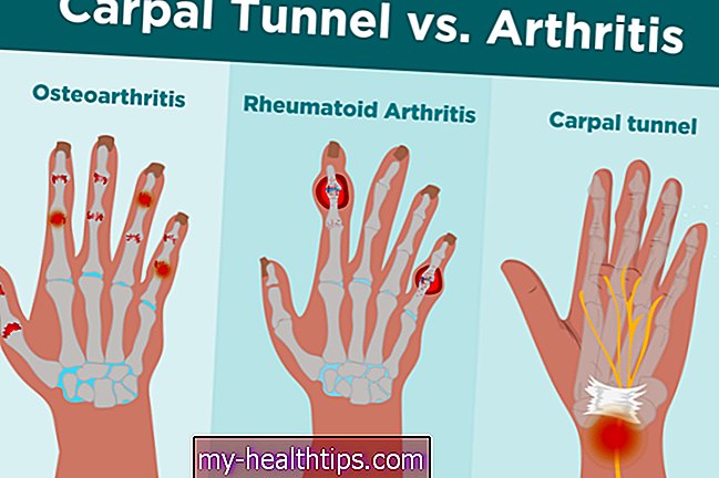 Karpaltunnel vs. Arthritis: Was ist der Unterschied?