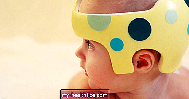 Kūdikio galvos formos pokyčiai: priežastys, gydymas ir rūpesčiai