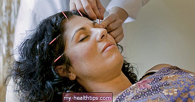 ¿Realmente la acupuntura vuelve a hacer crecer el cabello o es un mito?