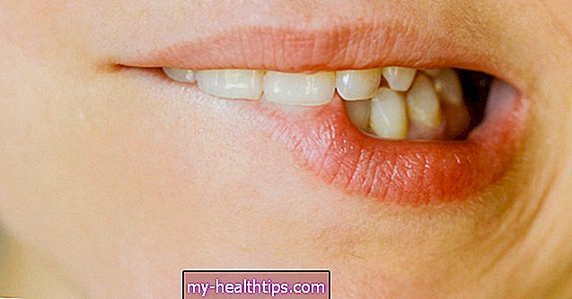 ¿Hacer estallar un herpes labial lo ayuda a sanar más rápido?