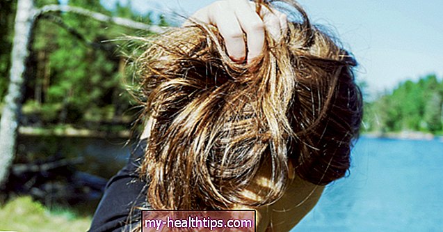 ¿Causa la psoriasis la caída del cabello?