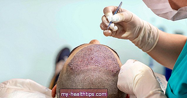 Alles, was Sie über eine FUE-Haartransplantation wissen sollten