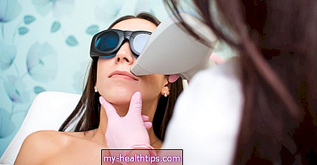 Vše, co byste měli vědět o laserovém odstraňování chloupků na obličeji