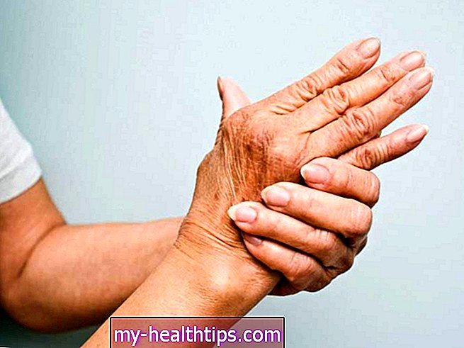 Alles, was Sie über Psoriasis-Arthritis wissen müssen