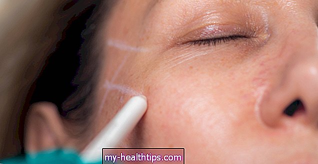 FaceTite: Hvad du behøver at vide om denne kosmetiske procedure