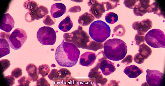 FLT3 mutacija ir ūminė mieloidinė leukemija: aplinkybės, paplitimas ir gydymas