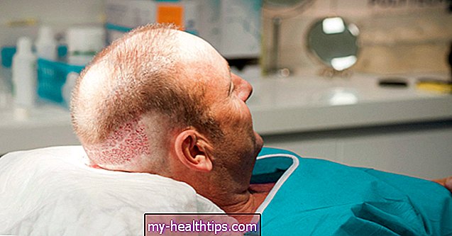 Transplantacija kose na ožiljcima: što treba znati