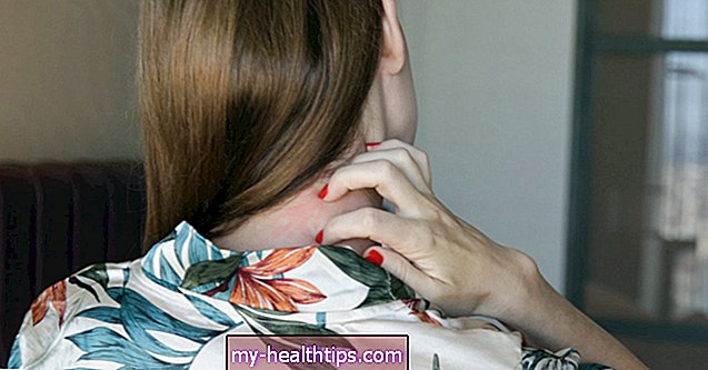 Как хепатит С може да повлияе на кожата ви
