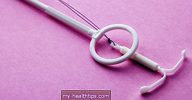 ¿Cómo se extrae un dispositivo intrauterino (DIU)?