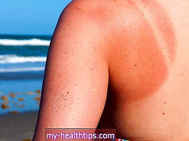Hoe lang duurt het voordat een zonnebrand geneest?