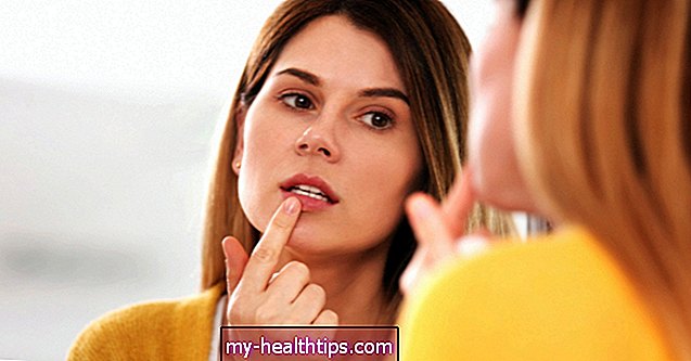 Cómo deshacerse de un herpes labial lo más rápido posible
