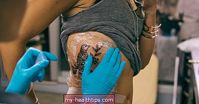 Cómo identificar y tratar una alergia a los tatuajes