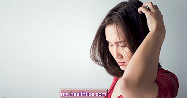 Wie man Gürtelrose auf der Kopfhaut behandelt