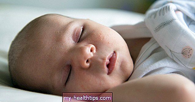 Cómo usar la leche materna para tratar el acné del bebé