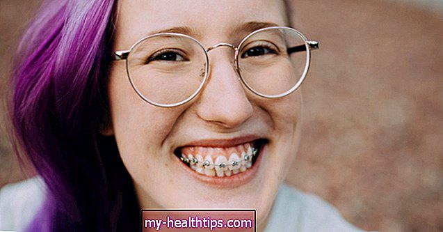क्या दंत मलिनकिरण ब्रेसिज़ स्थायी द्वारा कारण है?