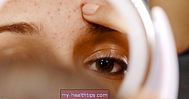 Proactiv: ¿Funciona y es el tratamiento adecuado para el acné para usted?