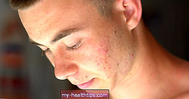 Retin-A para acne: o que esperar