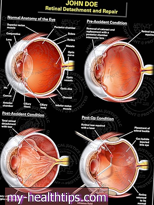 Repararea detașării retinei