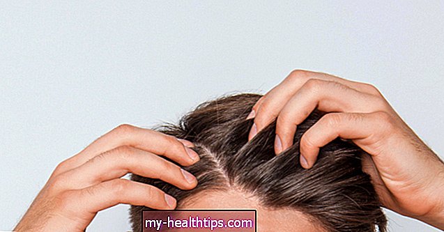 Costras y llagas en el cuero cabelludo: causas y tratamiento