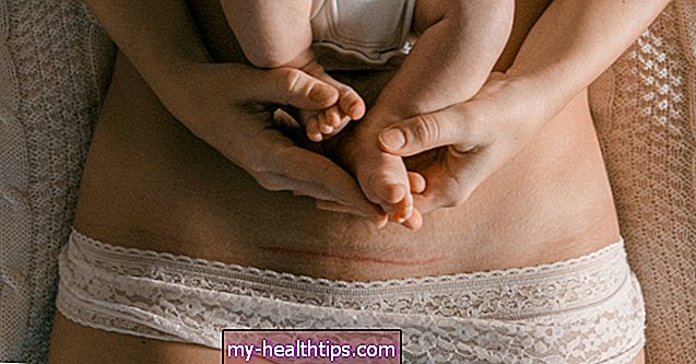 Anzeichen dafür, dass sich Ihre Kaiserschnitt-Inzision wieder öffnet und ärztliche Hilfe benötigt
