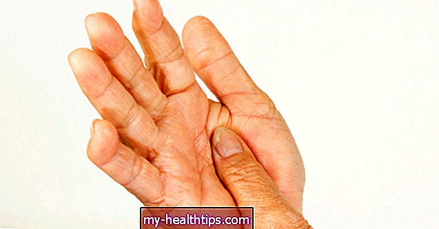 La diferencia entre el lupus y la artritis reumatoide