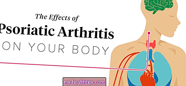Los efectos de la artritis psoriásica en el cuerpo