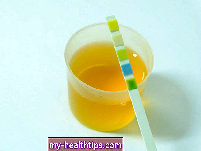 Preizkusi ravni kalcija v urinu