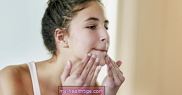 Cómo se ve el acné vulgar y cómo tratarlo