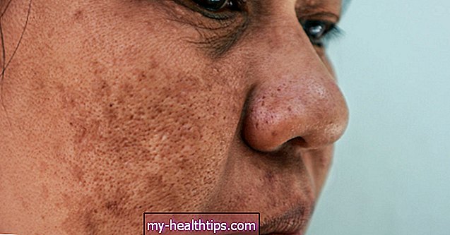 Was verursacht einen Melasma-Schnurrbart und wie behandelt man ihn?