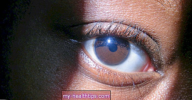 Was verursacht blaue Ringe um die Iris in Ihren Augen?