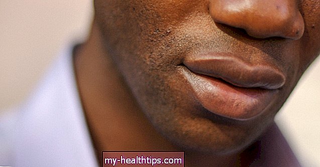 Što uzrokuje promjenu boje usana i kako to liječite?