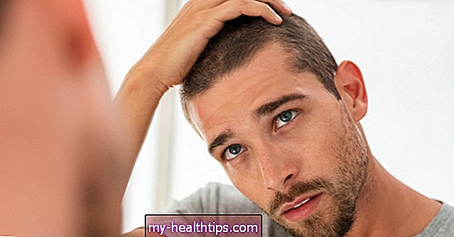 Kas sukelia kai kurių vyrų sausus, lūžinėjančius plaukus ir kaip juos gydyti