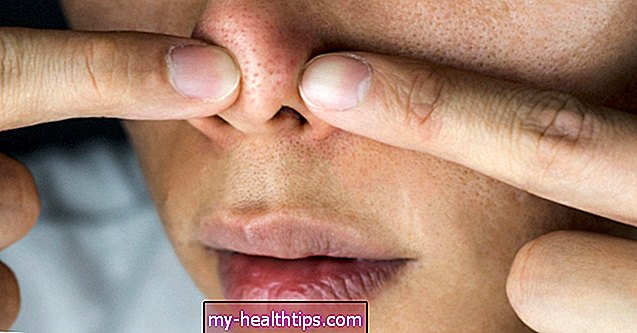 ¿Cuál es la materia blanca que sale cuando aprietas los poros de tu nariz?