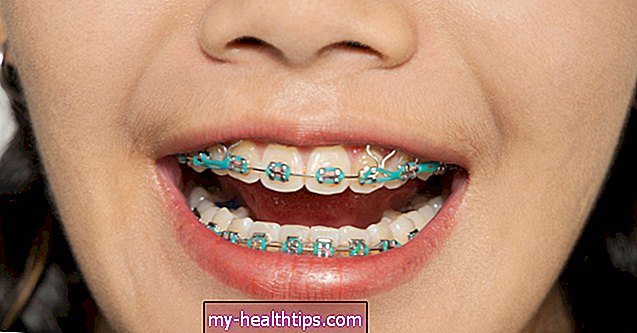 Welchen Zweck haben Gummibänder (Gummibänder) für Zahnspangen?