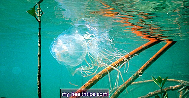 Što učiniti ako vas ubode otrovna kutija meduza