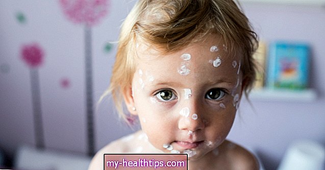 Qué esperar de la varicela en los bebés