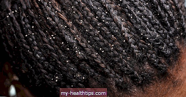 ¿Qué tipo de caspa está causando escamas en el cuero cabelludo?