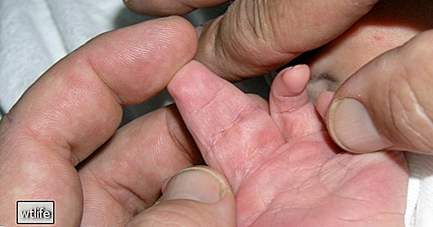 Lo que necesita saber sobre los dedos de las manos y los pies palmeados